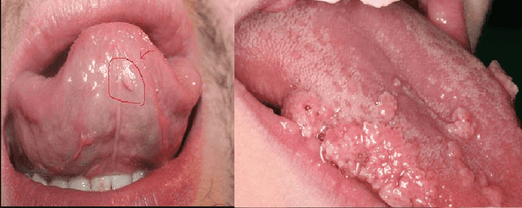 Bệnh sùi mào gà có tự khỏi được không và cách phòng tránh