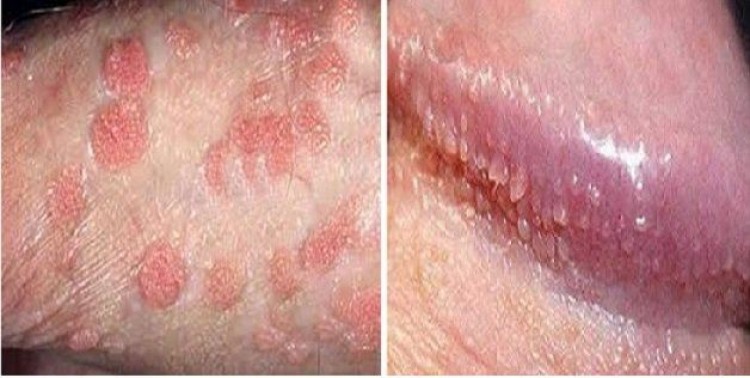 Bệnh sùi mào gà ở hậu môn: Nguyên nhân, dấu hiệu, cách chữa