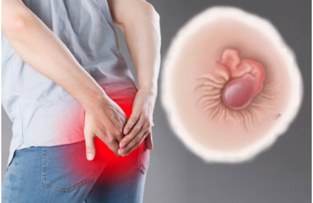 Hình ảnh bệnh trĩ nội, trĩ ngoại, trĩ hỗn hợp qua các giai đoạn