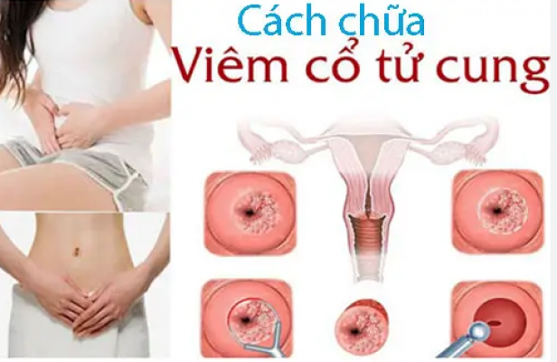 9 Cách chữa viêm cổ tử cung tại nhà hiệu quả nhất hiện nay