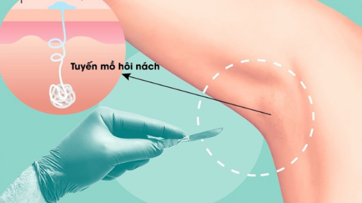 Chi phí cắt tuyến mồ hôi nách bao nhiêu tiền năm 2025? Bảng giá