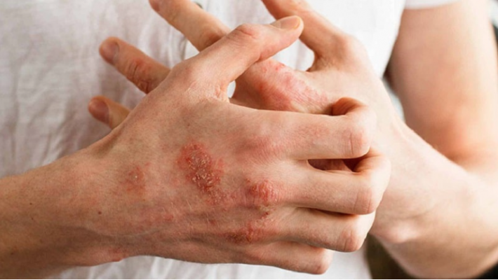 Top 8 cách chữa bệnh mụn rộp sinh dục hiệu quả an toàn tại nhà