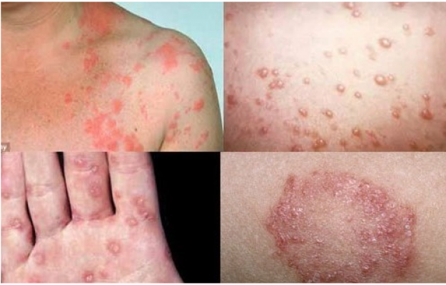 Hình ảnh bệnh lậu ở nam và nữ giới dễ nhận biết