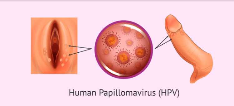 Virus HPV là gì? Dấu hiệu nhận biết và cách phòng tránh HPV