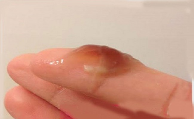 Khí hư màu nâu: Nguyên nhân dấu hiệu và cách chữa