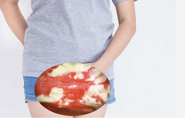 Hình ảnh bị nấm ở vùng kín nữ giới và cách chữa trị hiệu quả