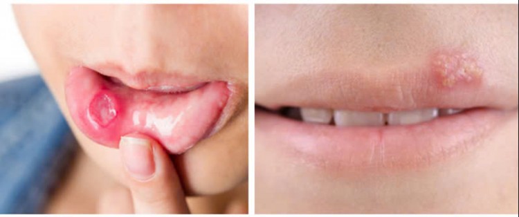 Phân biệt nhiệt miệng với bệnh sùi mào gà ở miệng
