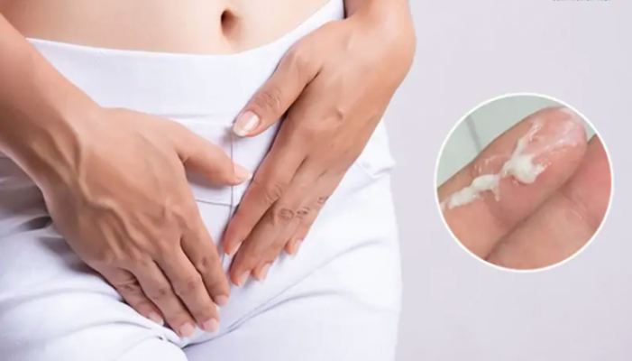 Huyết trắng vón cục như bã đậu và bị ngứa phải làm sao?