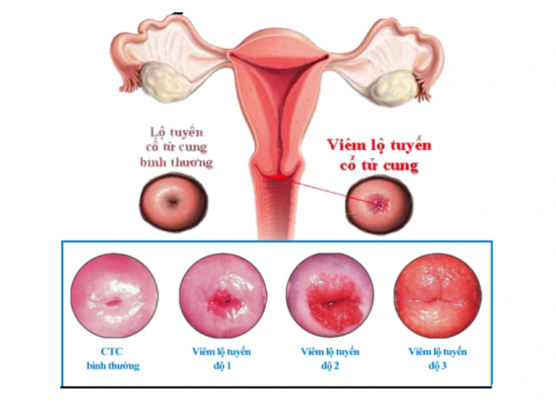 Viêm lộ tuyến cổ tử cung độ 3: Biểu hiện và cách điều trị