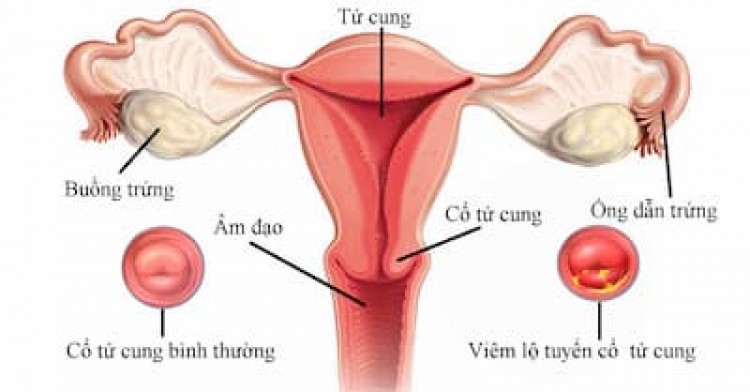 Phụ nữ bị u xơ tử cung có mang thai được không?