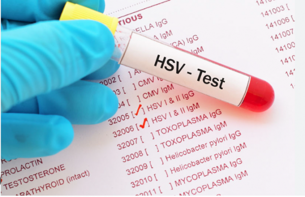 Virus HSV là gì? Nên xét nghiệm HSV ở đâu Hà Nội