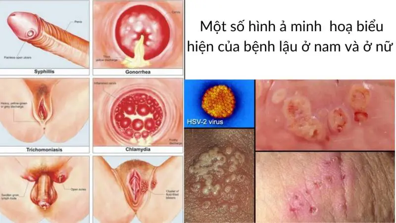 Dấu hiệu bệnh lậu