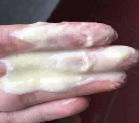 Hình ảnh khí hư bã đậu